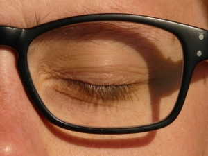 The results of an eyelid lifting can only be assessed objectively once the swelling has subsided